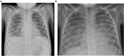 X-Linked Lymphoproliferative Disease Mimicking Multisystem Inflammatory Syndrome in Children—A Case Report